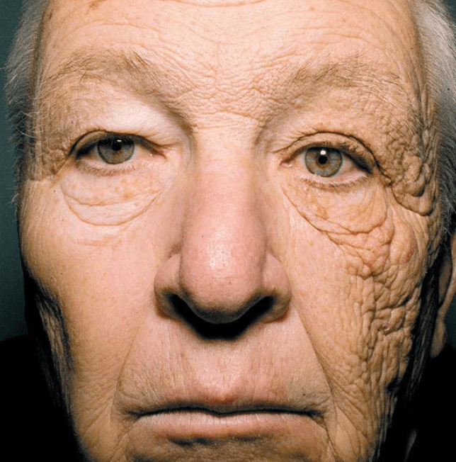 Another reason for skin aging? The SUN!