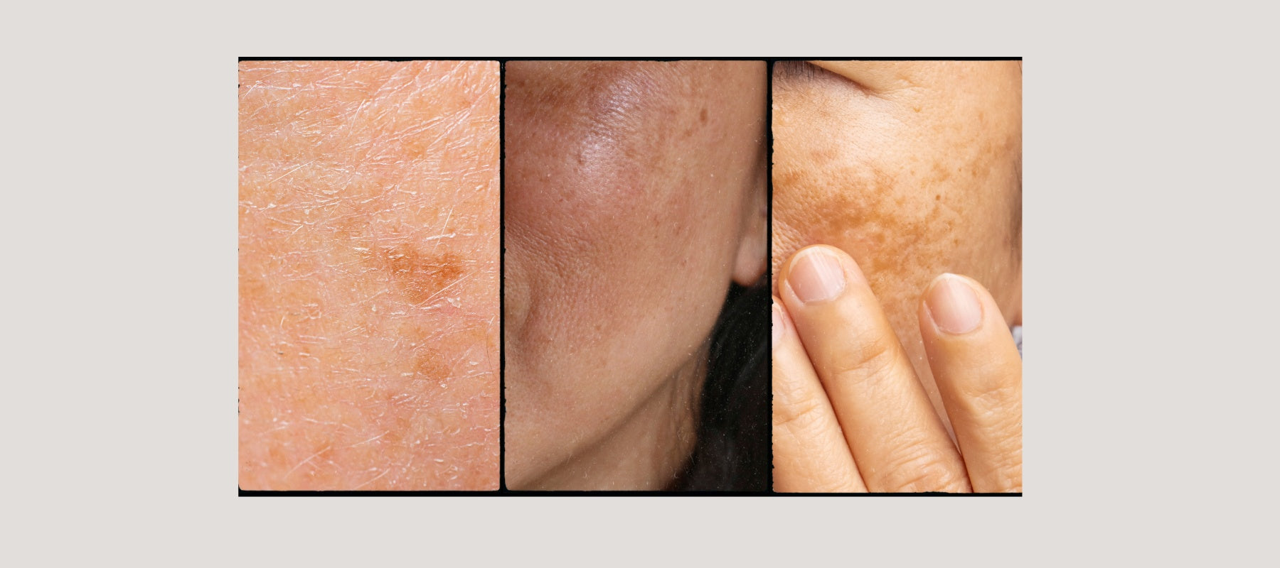 Preventing Age Spots: Understanding and Preventing Them